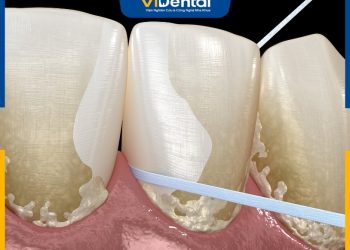 Bảng Giá Cạo Vôi Răng
