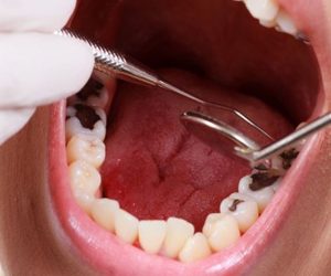 Tình trạng răng miệng
