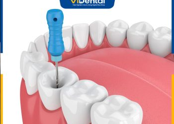 Bảng Giá Điều Trị Tủy Răng