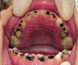 Tình trạng răng miệng