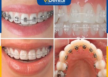 Bảng Giá Niềng Răng Mắc Cài