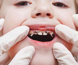 Tình trạng răng miệng của trẻ