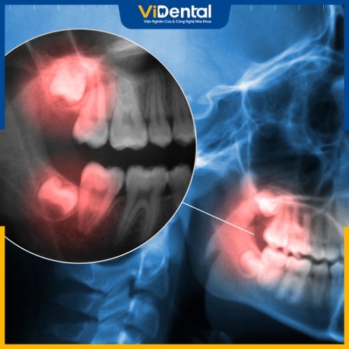 Phần chân răng thường xuyên có hiện tượng bị chảy máu
