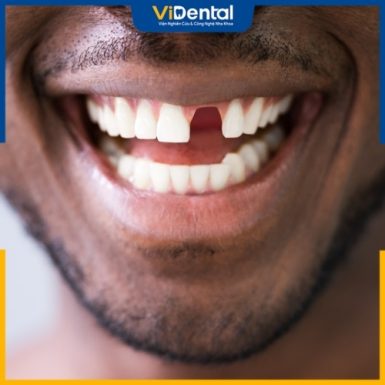 Nên phục hình răng sớm khi bị mất răng