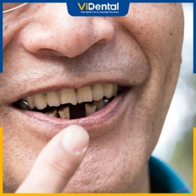 Mất răng làm hạn chế chức năng răng miệng