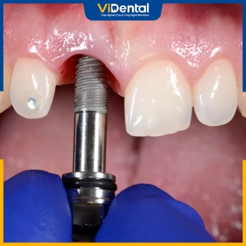 Trồng răng cửa bằng Implant