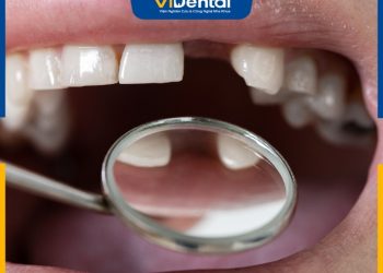 Mất 1 Răng Cửa: Nguyên Nhân, Hậu Quả Và Cách Phục Hình Răng