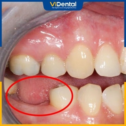 Mất 1 răng răng có thể ảnh hưởng đến răng kế cạnh