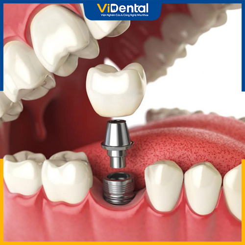 Trồng răng Implant mang đến hiệu quả vượt trội 