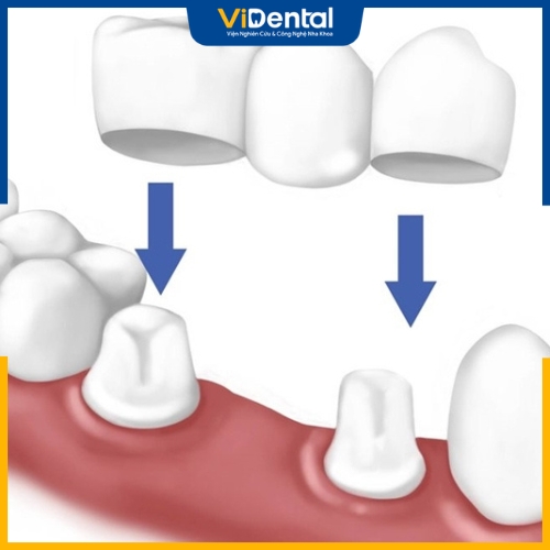 Cầu răng sứ khắc phục mất 1 răng hàm
