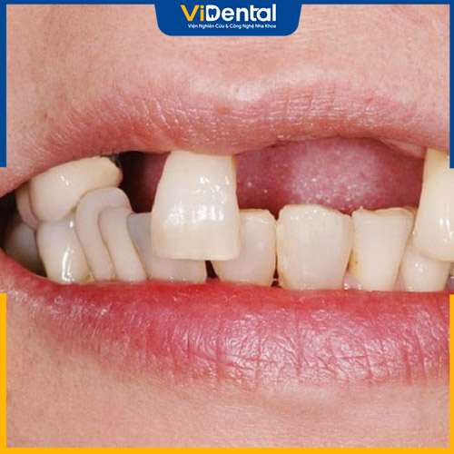 Bệnh nhân bị mất nhiều răng không liền nhau 