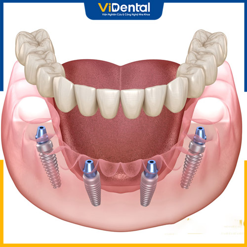 Trồng răng Implant là biện pháp điều trị mất răng hiệu quả 