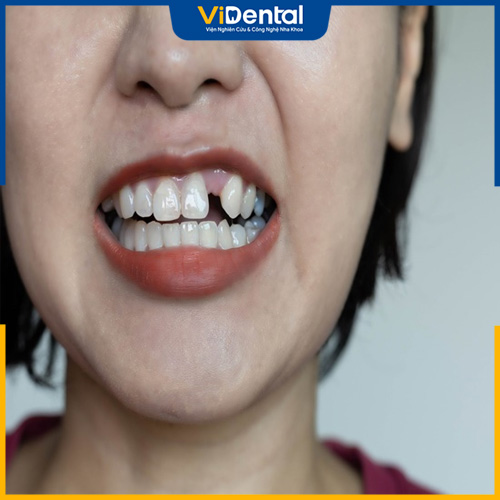 Mất nhiều răng không liền kề làm giảm khả năng an, nhai