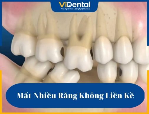 Mất nhiều răng không liền kề là bệnh lý nha khoa có mức độ nghiêm trọng cao