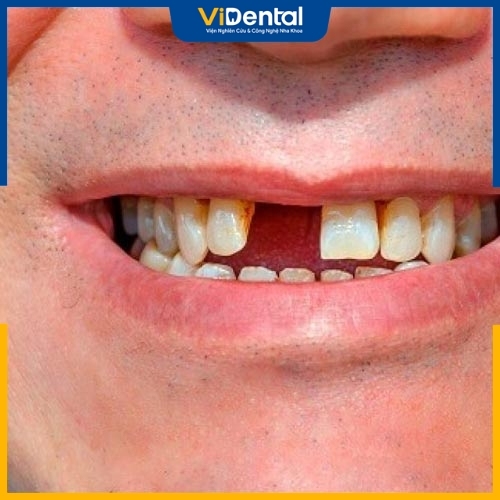 Mất răng ảnh hưởng tới nhiều khía cạnh cuộc sống