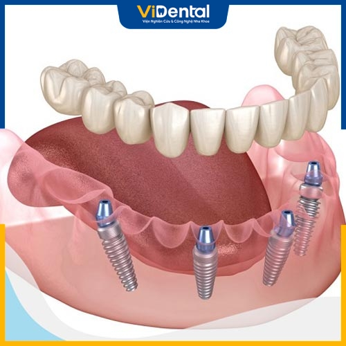 Trồng răng Implant là giải pháp phục hồi tối ưu nhất