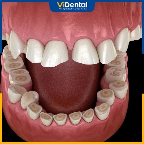 Răng bị bào mòn do các chất acid tác động