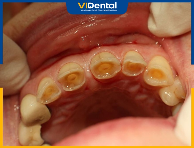 Mòn Răng: Nguyên Nhân, Hậu Quả, Cách Khắc Phục Và Ngăn Ngừa