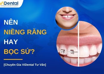 Nên niềng răng hay bọc sứ