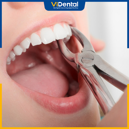 Nhổ răng để đảm bảo sức khỏe răng miệng