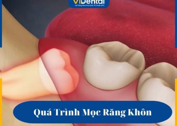 Quá trình mọc răng khôn diễn ra như thế nào