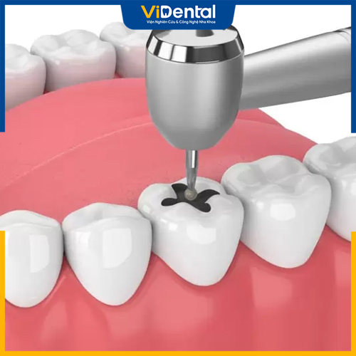 Trám răng giúp hoàn thiện răng sứt, mẻ, sâu
