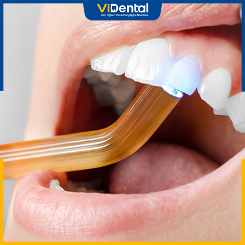 Quy trình trám răng thường được diễn ra nhanh chóng