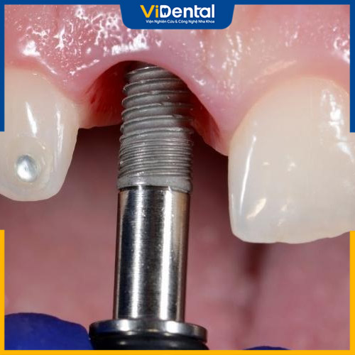 Gắn trụ Implant vào vị trí răng bị mất cho bệnh nhân