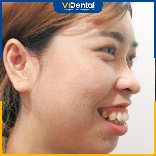Răng hô hàm trên là trường hợp phổ biến nhất