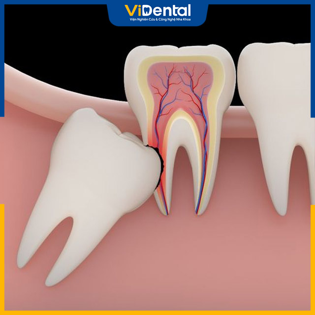 Tình trạng này có thể làm ảnh hưởng đến các răng bên cạnh