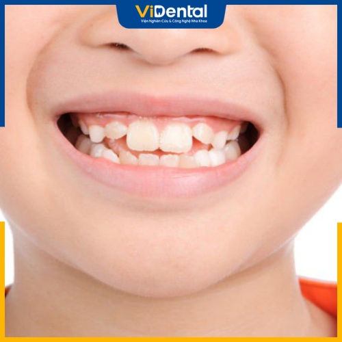 Răng mọc không đều xuất phát từ nhiều nguyên nhân khác nhau 