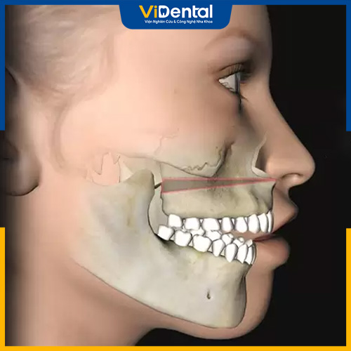 Các răng mọc nghiêng lệch có thể chèn ép dây thần kinh 