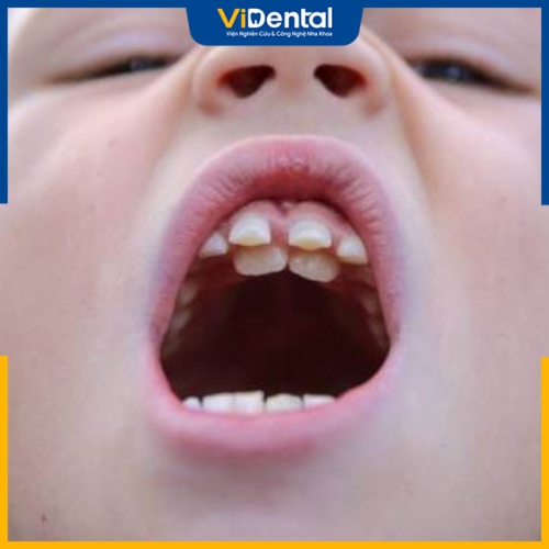 Răng mọc lệch là tình trạng răng mọc khấp khểnh