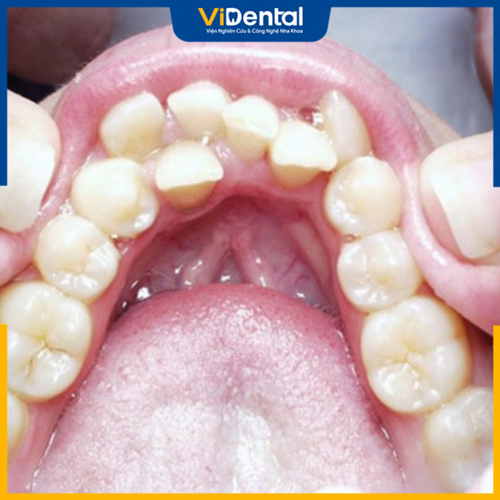 Răng hàm dưới mọc lộn xộn là một trong những dấu hiệu răng mọc lệch