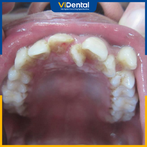 Răng mọc sai lệch có thể xuất phát từ yếu tố di truyền