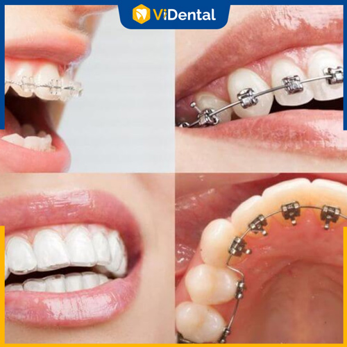 Niềng răng là biện pháp khắc phục tình trạng răng lệch lạc hiệu quả nhất 