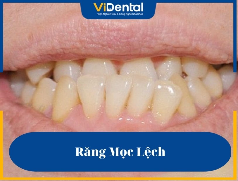 Răng Mọc Lệch: Dấu Hiệu Nhận Biết, Nguyên Nhân Và Cách Khắc Phục