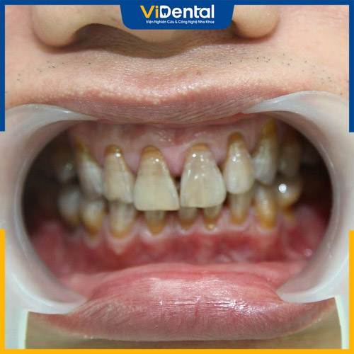 Răng nhiễm màu là tình trạng màu sắc răng chuyển vàng, đen