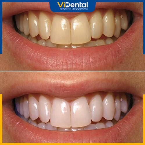 Tẩy trắng răng giúp loại bỏ mảng bám, vết ố vàng trên răng