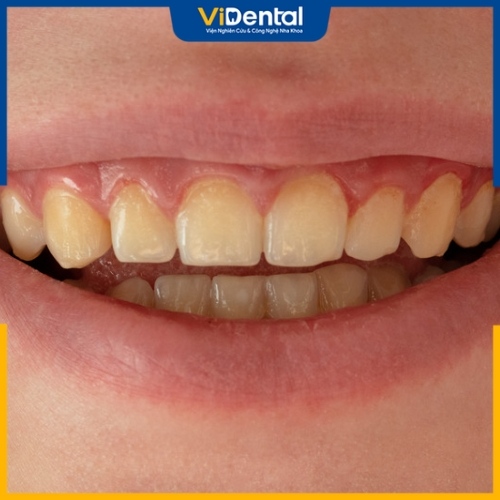 Răng ố vàng là tình trạng răng miệng thường gặp