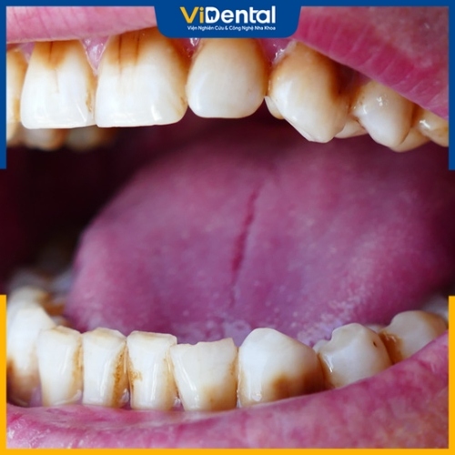 Răng bị ố vàng ảnh hưởng không tốt tới sức khỏe