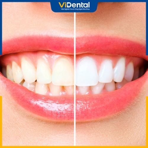 Tẩy trắng răng xử lý ố vàng mức độ nhẹ