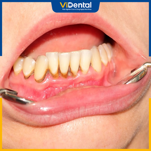 Mảng bám cao răng gây sâu răng