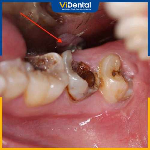 Sâu răng hàm là tình trạng răng số 6, 7 và 8 bị tổn thương