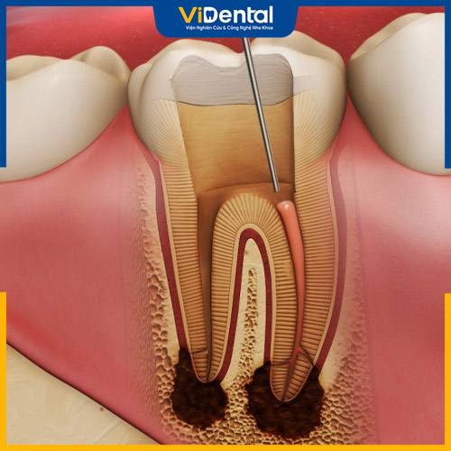 Chết tủy là giai đoạn nghiêm trọng của sâu răng hàm