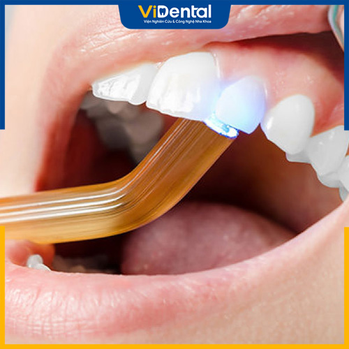 Trám răng sâu là kỹ thuật nha khoa đơn giản