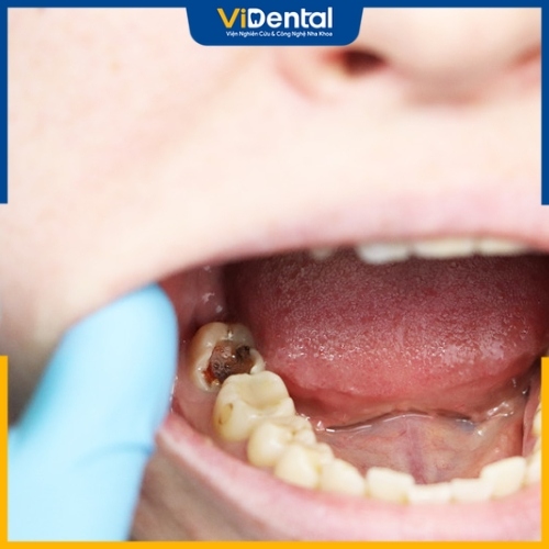 Sâu răng là bệnh lý có thể gặp ở mọi đối tượng