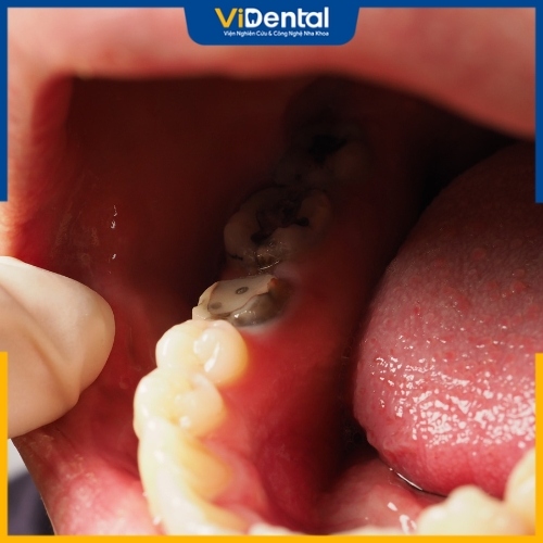 Vi khuẩn phá hủy lớp men răng khiến tình trạng sâu răng nặng hơn