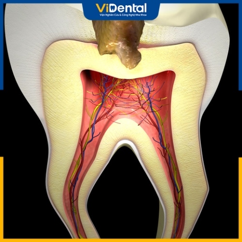 Sâu răng phá hủy toàn bộ cấu trúc có thể gây chết tủy răng