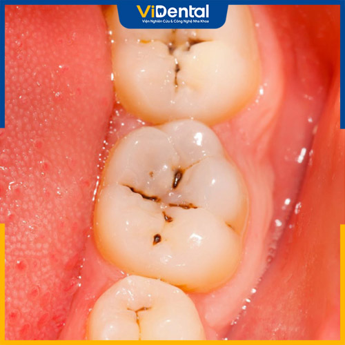 Sâu răng nhẹ là giai đoạn đầu của sâu răng